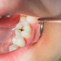 10 Strategies to Prevent Cavities and Other Dental Issues: An Expert's Guide