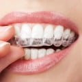 Caring for Your Veneers: A Comprehensive Guide