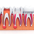 Special Considerations for People with Root Canals' Dental Care