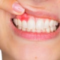 Special Considerations for People with Gum Disease in Dental Care