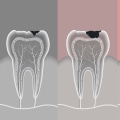 What Should I Do If I Have a Cavity or Other Dental Issue?