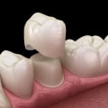 Caring for Your Dental Crown: What You Need to Know