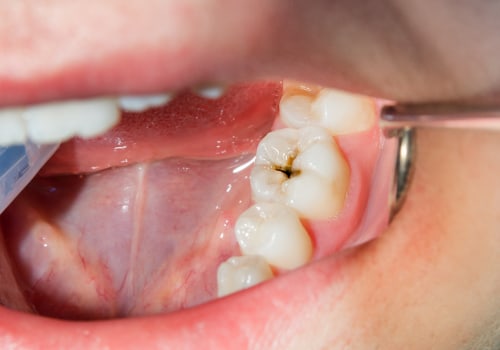 10 Strategies to Prevent Cavities and Other Dental Issues: An Expert's Guide