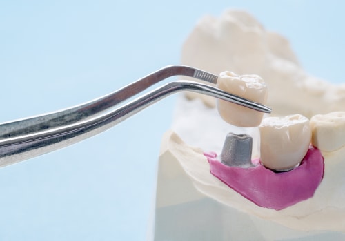The Pros and Cons of Dental Crowns: What You Need to Know