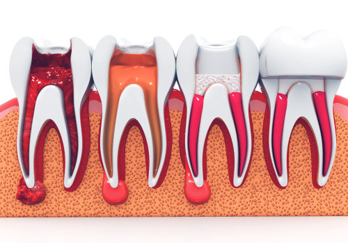 Special Considerations for People with Root Canals' Dental Care