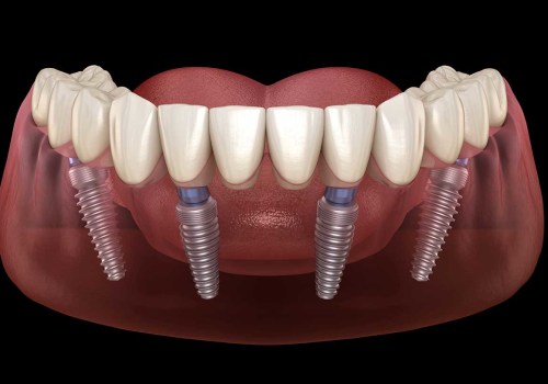 Dental Implants: What You Need to Know Before Getting One