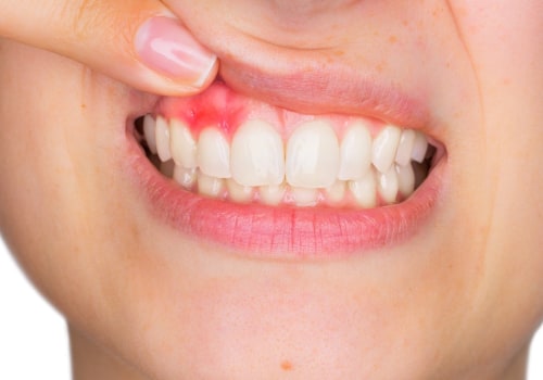 Special Considerations for People with Gum Disease in Dental Care